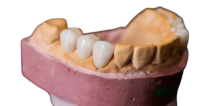 013 Blog Cantidad Carillas Dentales Removebg Preview | ANGEL LUIS ROMERO DE MIGUEL